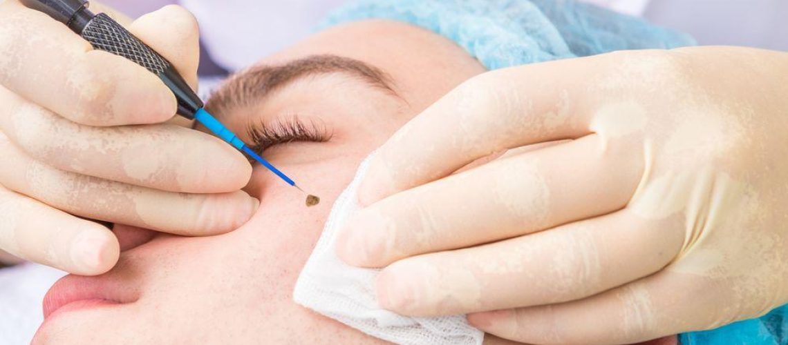 برداشتن خال در تبریز