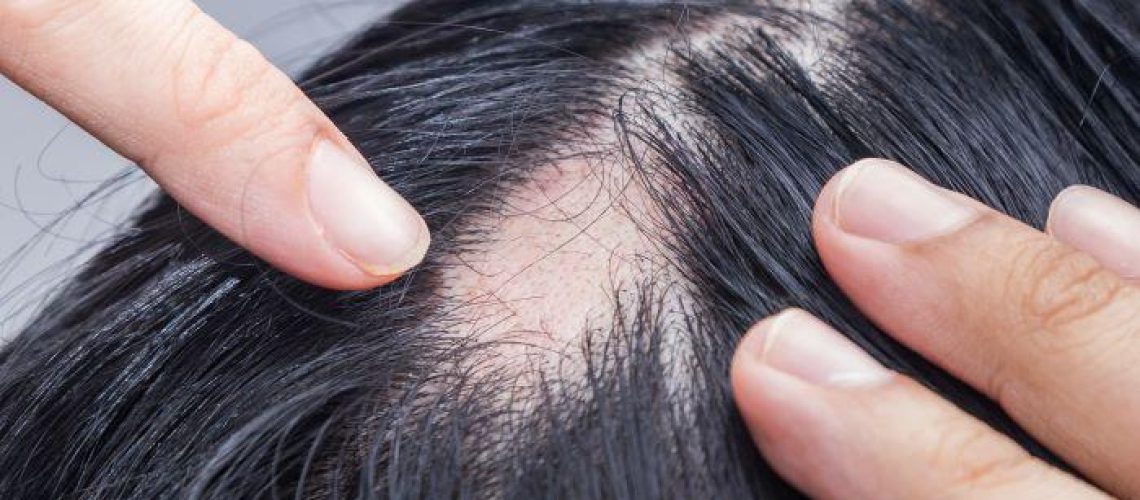 دکتر آلوپسی در تهران